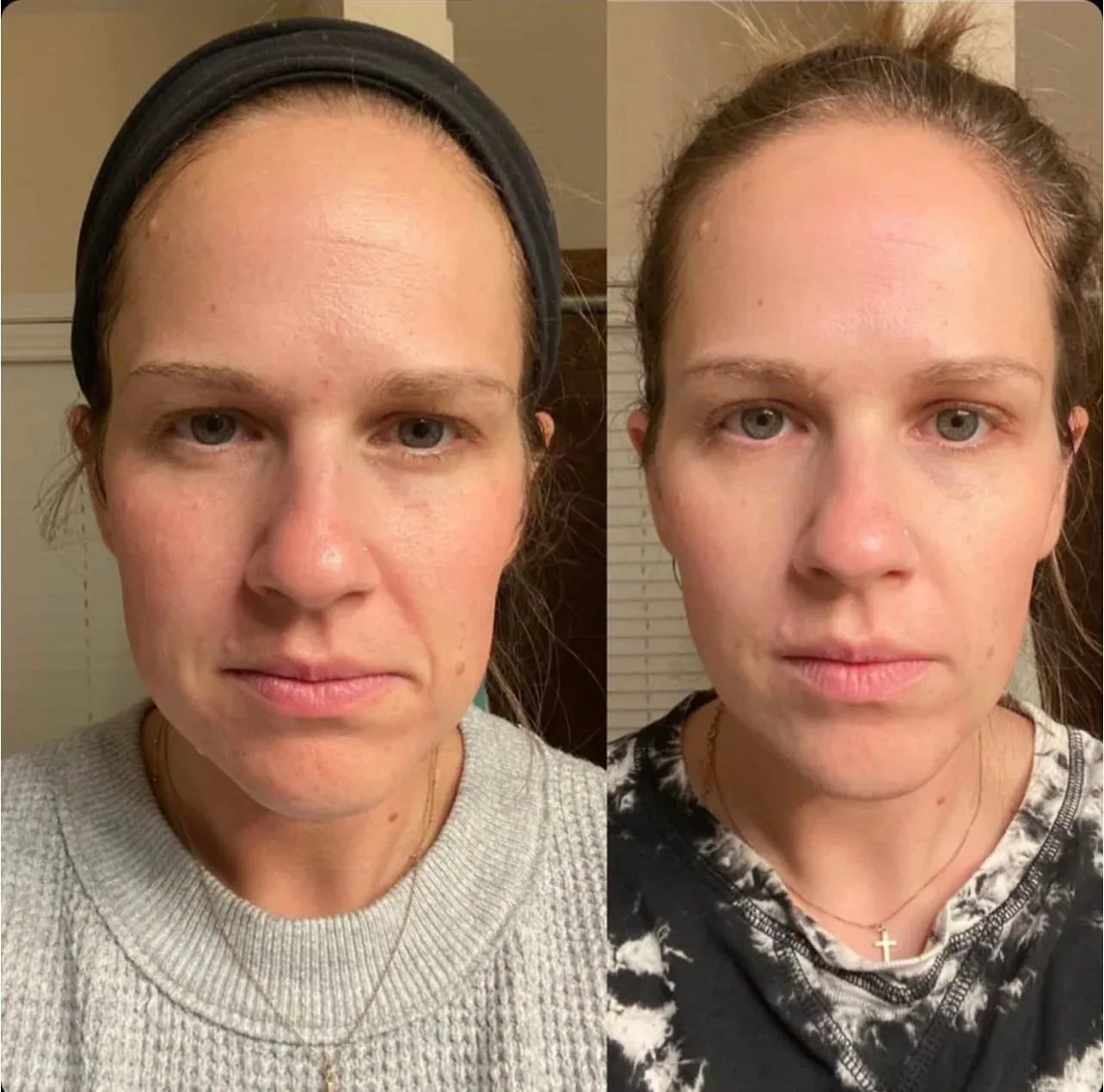 Elev Tapes - Facial Lift Japanese Tapes - Botox Alternative | Anti-Wrinkle